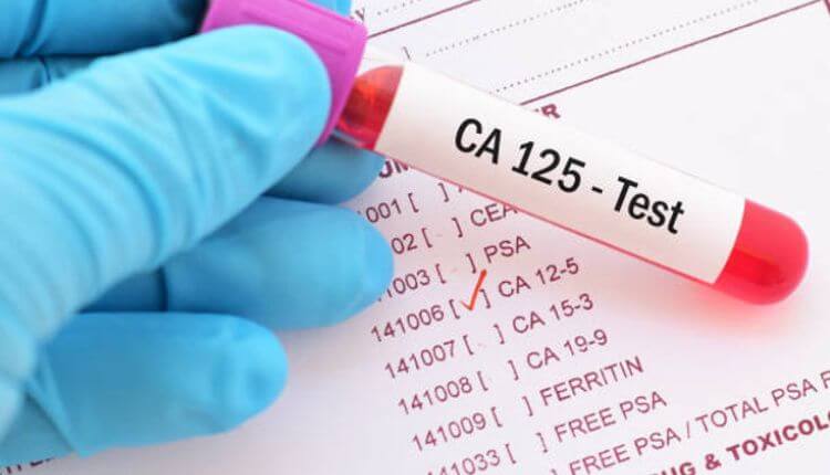 Ovarian Cancer Screening (Ultrasound & CA-125 Test)