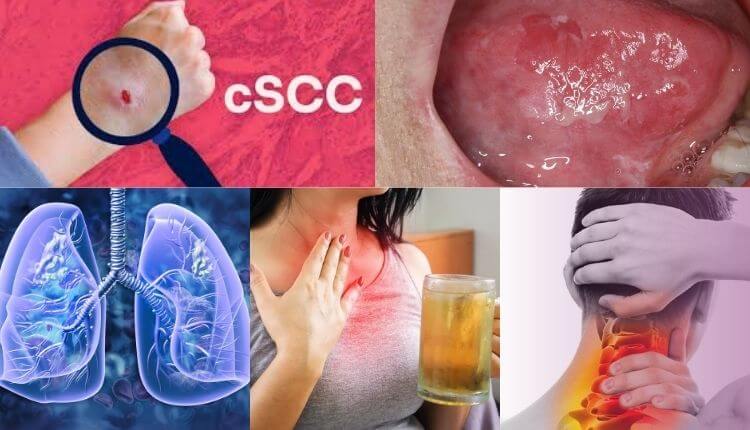 Types of Squamous Cell Carcinoma