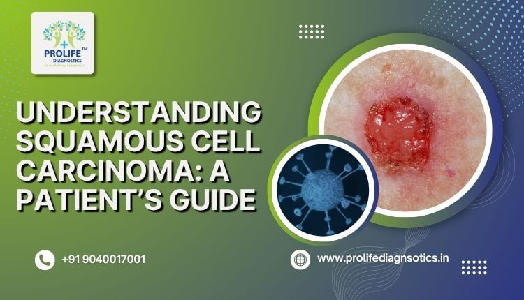 Understanding Squamous Cell Carcinoma A Patient’s Guide