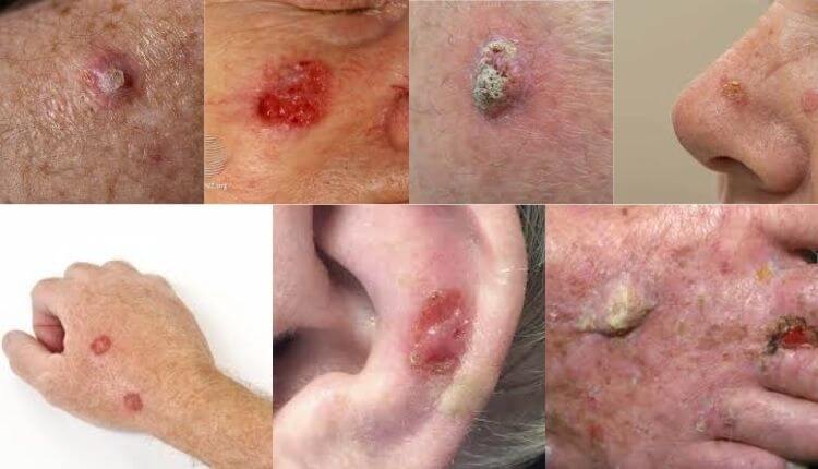 Squamous Cell Carcinoma on sun-exposed skin areas.