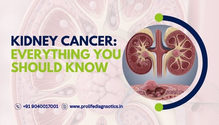 Kidney Cancer Everything You Should Know