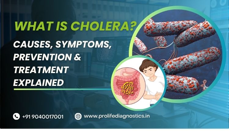 What is Cholera Causes, Symptoms, Prevention & Treatment Explained